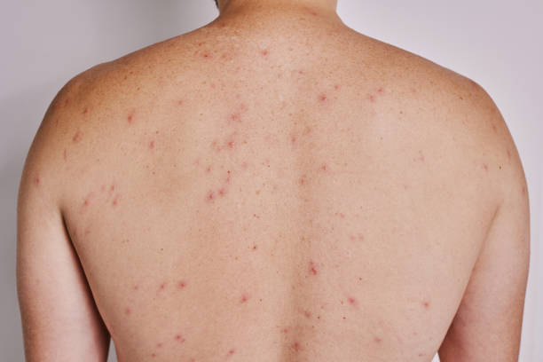 Back Acne Treatment in Singapore